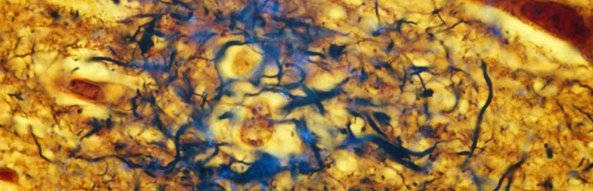 Stopping Alzheimer's disease before it starts Stopping Alzheimer's disease before it starts